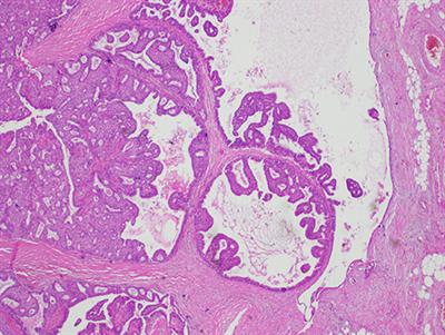 Encapsulated Papillary Carcinoma: A Case Report and Review of the Literature